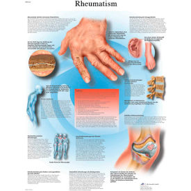Anatomical Chart - Rheumatic Diseases, Paper