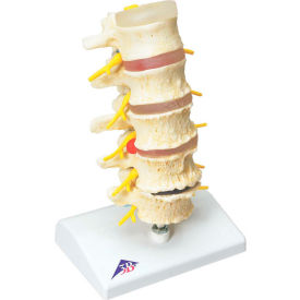 Anatomical Model - Vertebrae Degeneration, Stages of Prolapsed Disc