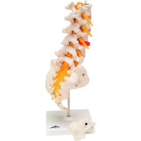 Anatomical Model - Lumbar Spinal Column with Dorso-Lateral Prolapsed Disc