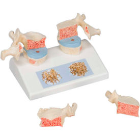 Anatomical Model - Osteoporosis Model