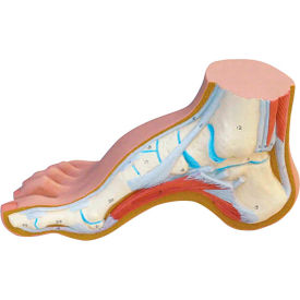 Anatomical Model - Hollow Foot (Pes Cavus)