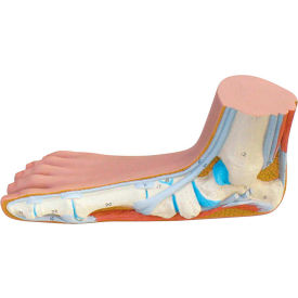 Anatomical Model - Flat Foot (Pes Panus)