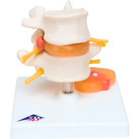 Anatomical Model - Lumbar Spinal Column with Prolapsed Intervertebral Disc