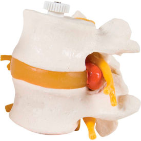 Anatomical Model - 2 Lumbar Vertebrae with Prolapsed Disc, Flexibly Mounted