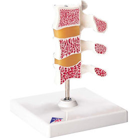 Anatomical Model - Deluxe Osteoporosis (3 Vertebrae)