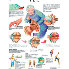 Anatomical Chart - Arthritis, Paper